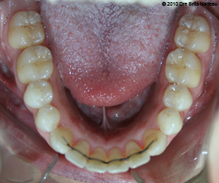 Marie-Hélène Cyr - Lower occlusal view - After orthodontic treatments and orthognathic surgeries (January 29, 2010)